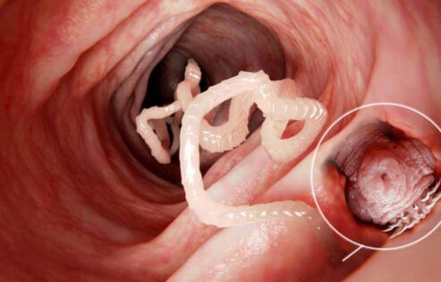 蠕虫是人体内的寄生虫